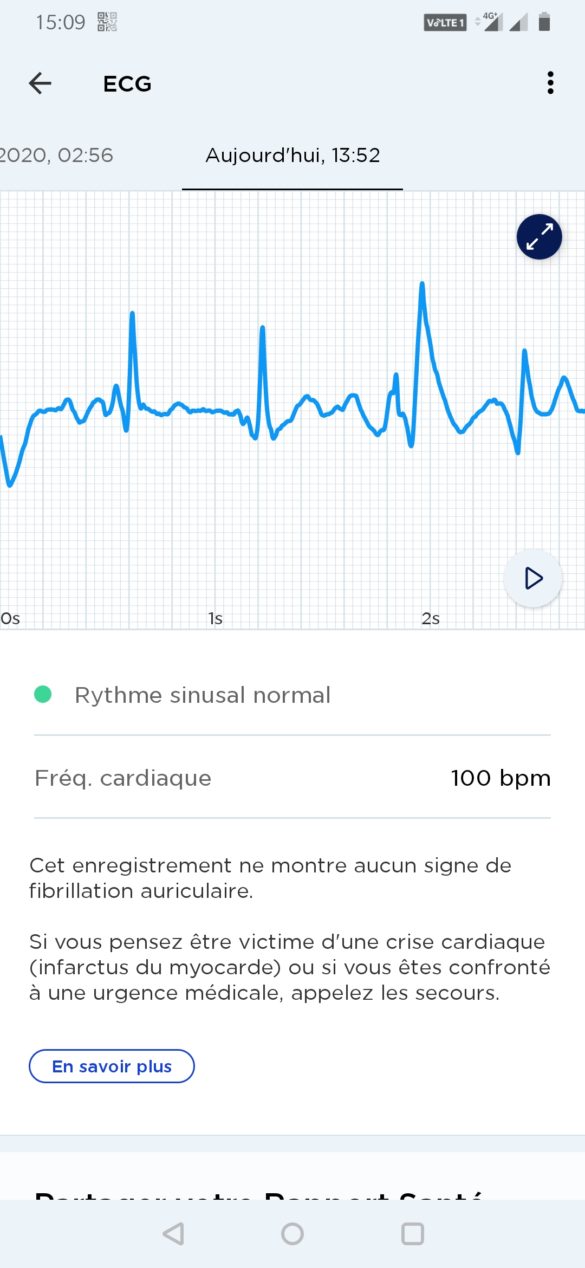 ECG scanwatch